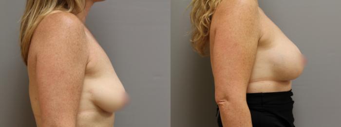 Augmentation, Right Side Photo, Calgary Alberta, Demsey Plastic Surgery 
