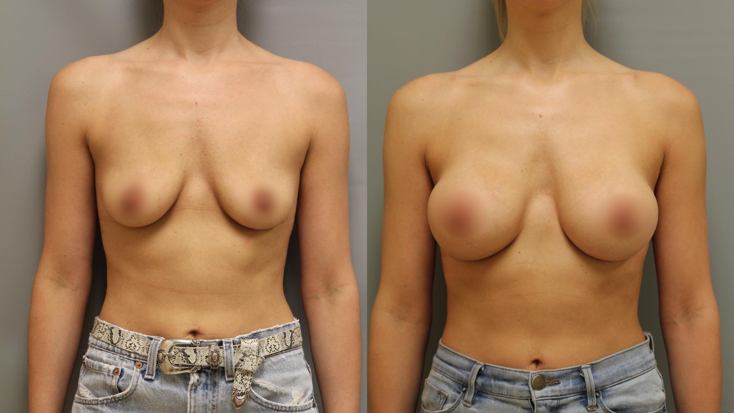 Augmentation, Front Photo, Calgary Alberta, Demsey Plastic Surgery 