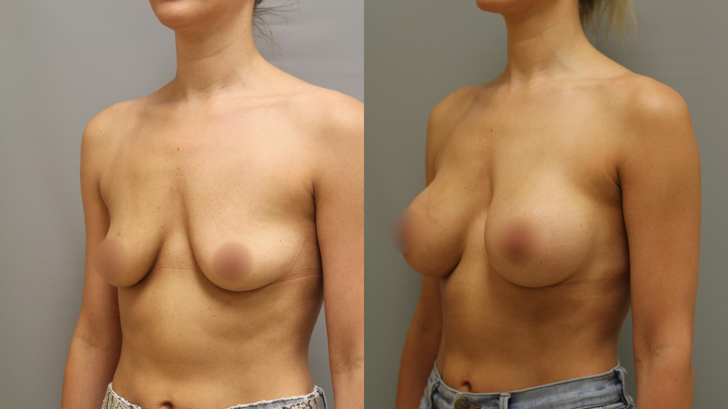 Augmentation, Left Oblique Photo, Calgary Alberta, Demsey Plastic Surgery 