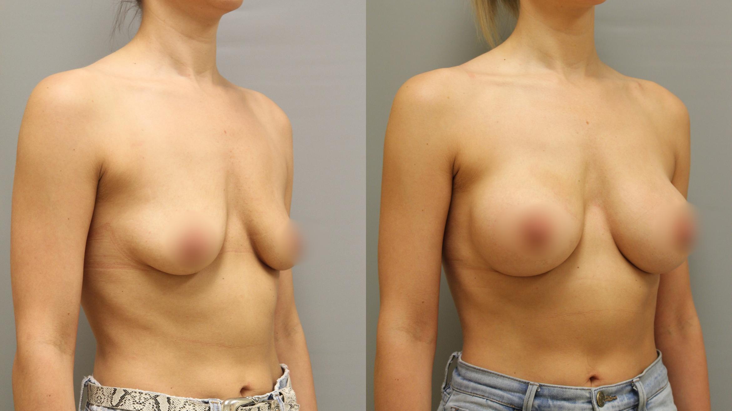 Augmentation, Right Oblique Photo, Calgary Alberta, Demsey Plastic Surgery 