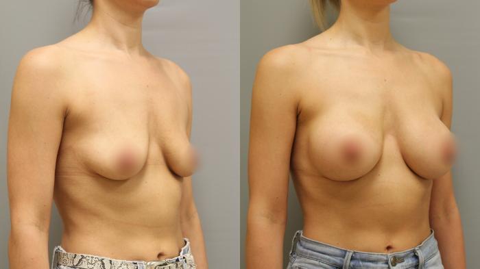 Augmentation, Right Oblique Photo, Calgary Alberta, Demsey Plastic Surgery 