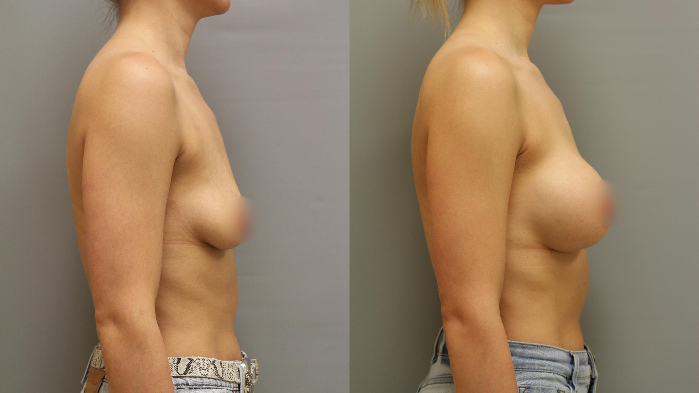 Augmentation, Right Side Photo, Calgary Alberta, Demsey Plastic Surgery 