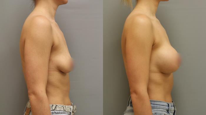 Augmentation, Right Side Photo, Calgary Alberta, Demsey Plastic Surgery 