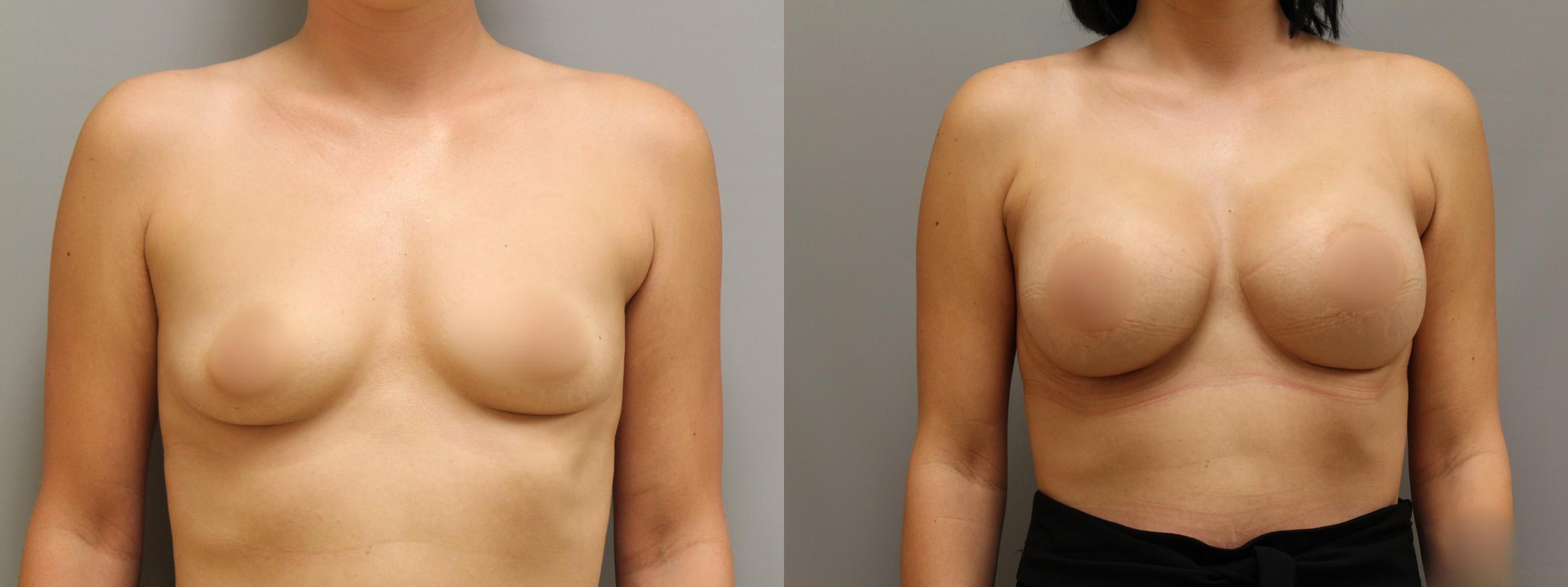 Augmentation, Front Photo, Calgary Alberta, Demsey Plastic Surgery 