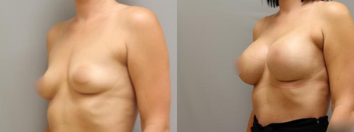 Augmentation, Left Oblique Photo, Calgary Alberta, Demsey Plastic Surgery 