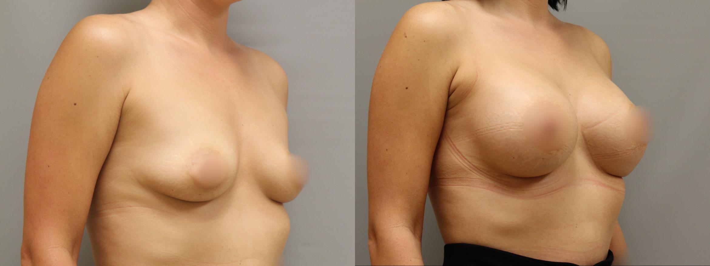 Augmentation, Right Oblique Photo, Calgary Alberta, Demsey Plastic Surgery 
