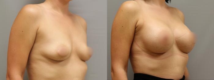 Augmentation, Right Oblique Photo, Calgary Alberta, Demsey Plastic Surgery 