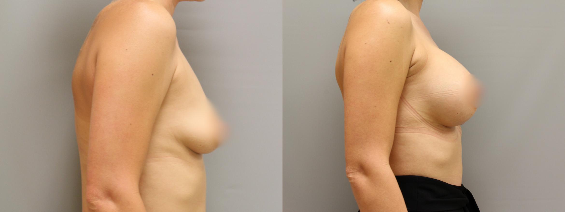 Augmentation, Right Side Photo, Calgary Alberta, Demsey Plastic Surgery 