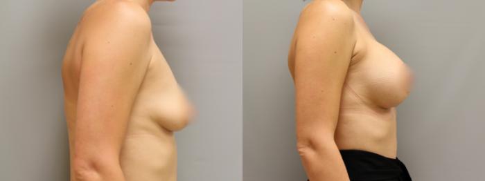 Augmentation, Right Side Photo, Calgary Alberta, Demsey Plastic Surgery 