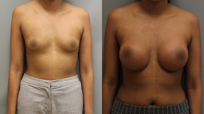 Augmentation, Front Photo, Calgary Alberta, Demsey Plastic Surgery 