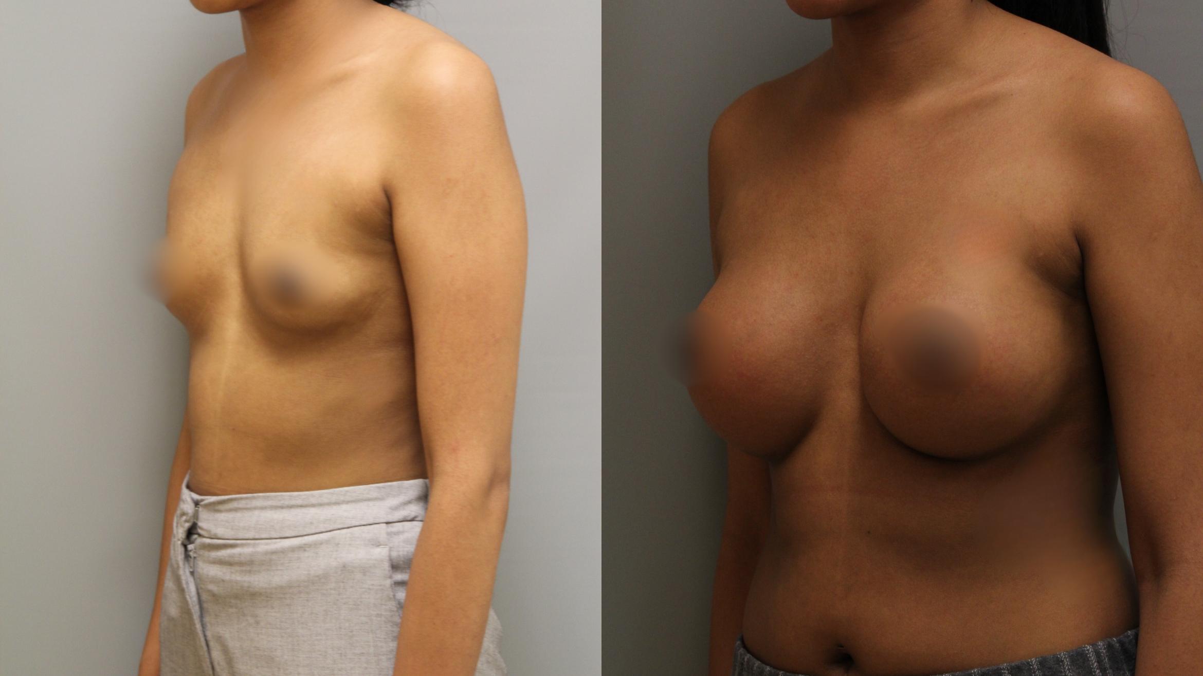 Augmentation, Left Oblique Photo, Calgary Alberta, Demsey Plastic Surgery 