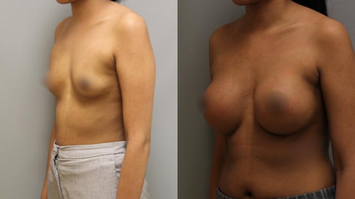 Augmentation, Left Oblique Photo, Calgary Alberta, Demsey Plastic Surgery 