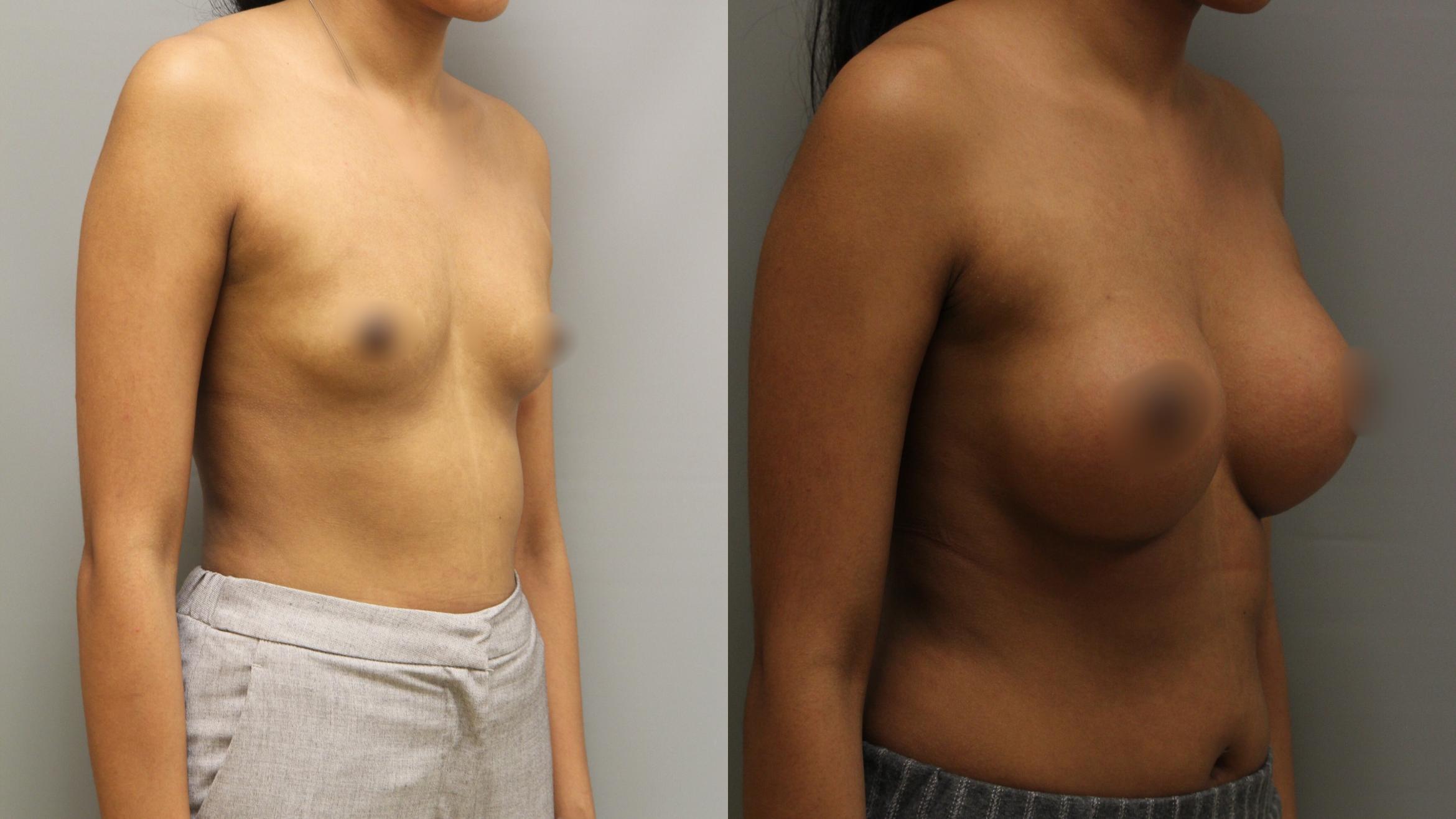 Augmentation, Right Oblique Photo, Calgary Alberta, Demsey Plastic Surgery 