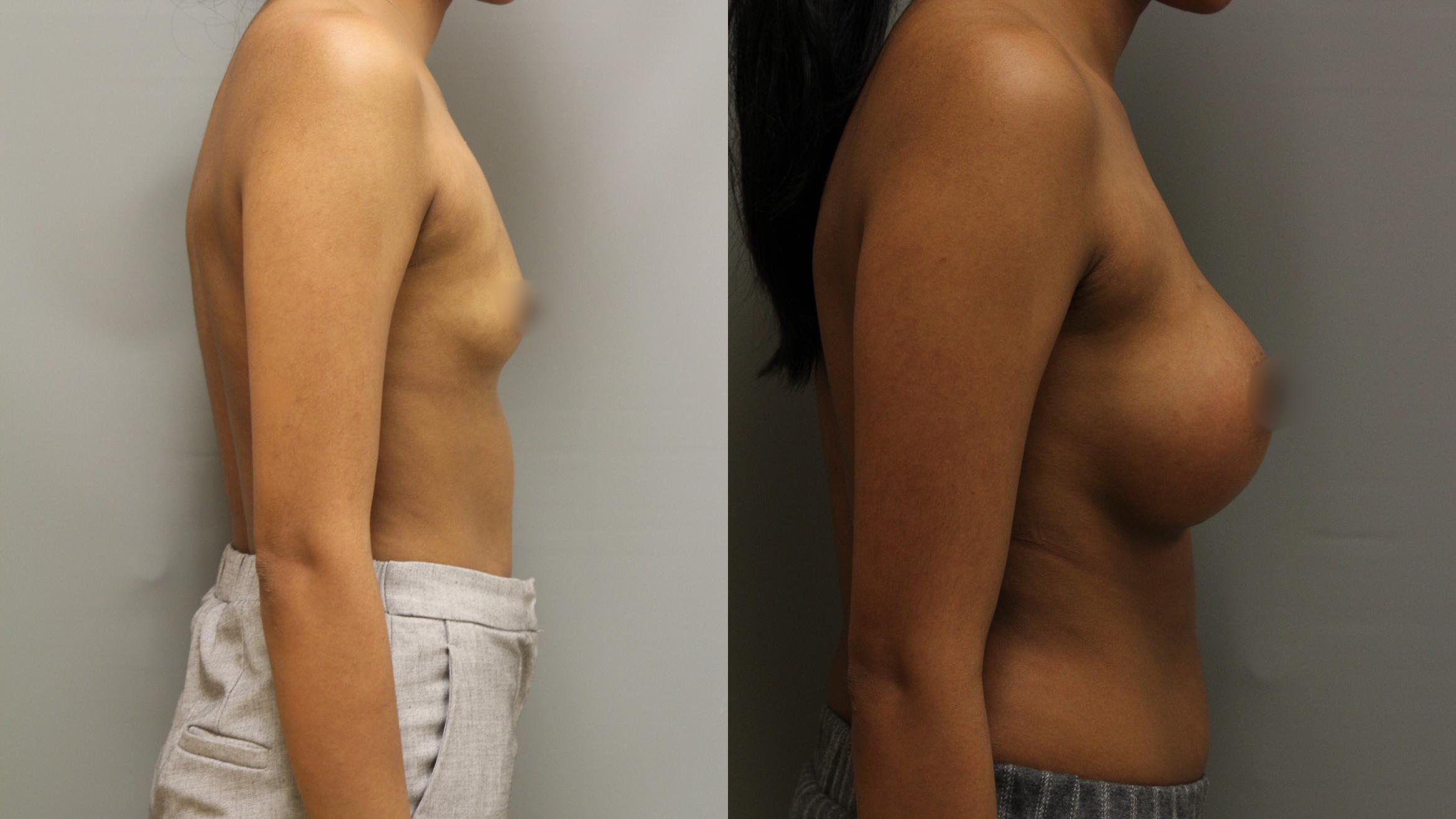 Augmentation, Right Side Photo, Calgary Alberta, Demsey Plastic Surgery 