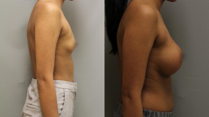 Augmentation, Right Side Photo, Calgary Alberta, Demsey Plastic Surgery 