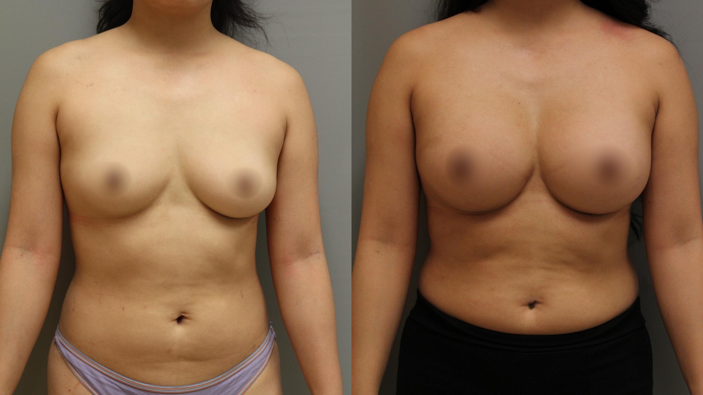 Augmentation, Front Photo, Calgary Alberta, Demsey Plastic Surgery 