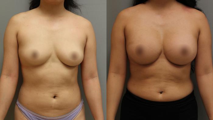 Augmentation, Front Photo, Calgary Alberta, Demsey Plastic Surgery 