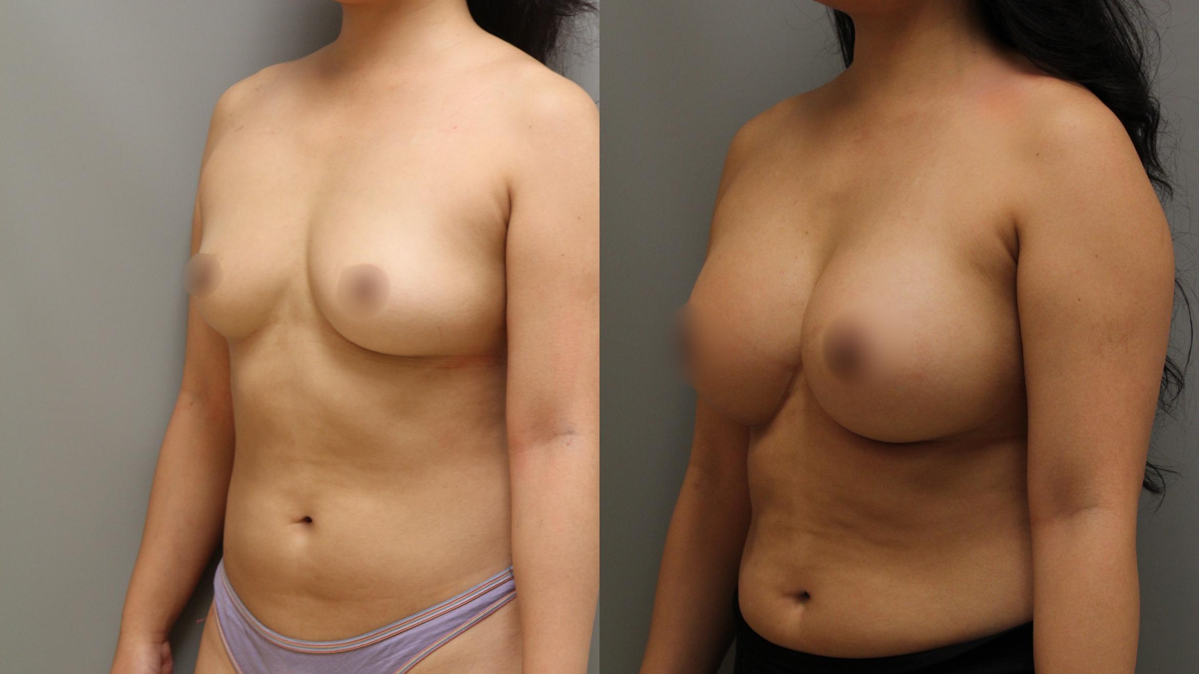 Augmentation, Left Oblique Photo, Calgary Alberta, Demsey Plastic Surgery 