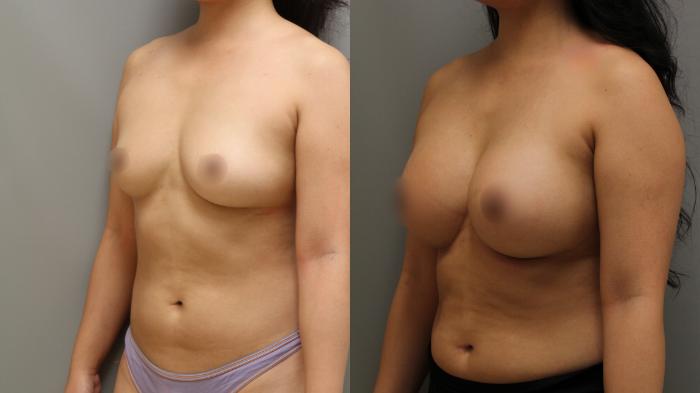Augmentation, Left Oblique Photo, Calgary Alberta, Demsey Plastic Surgery 