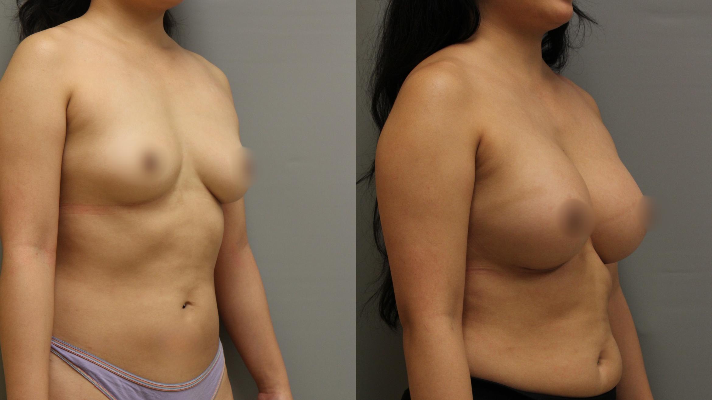 Augmentation, Right Oblique Photo, Calgary Alberta, Demsey Plastic Surgery 
