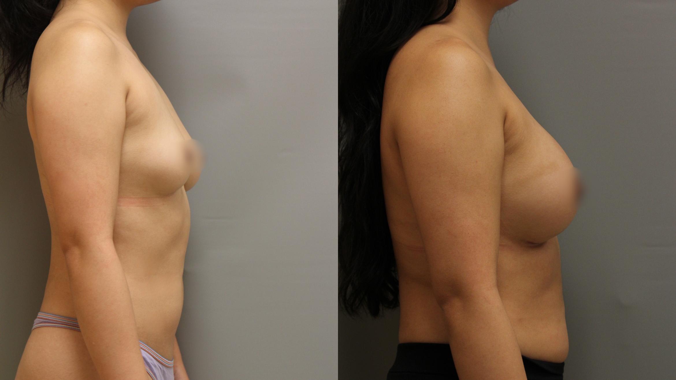 Augmentation, Right Side Photo, Calgary Alberta, Demsey Plastic Surgery 