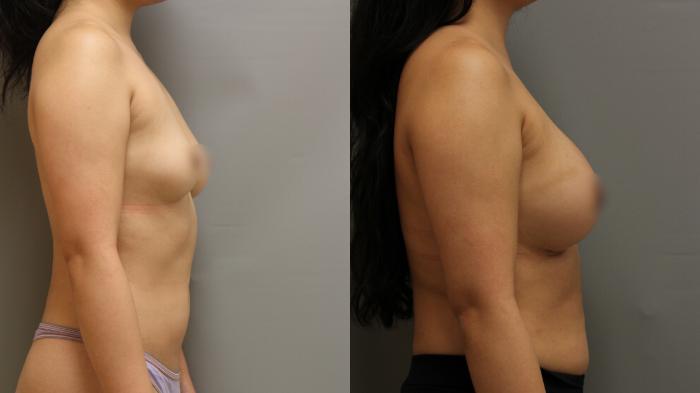 Augmentation, Right Side Photo, Calgary Alberta, Demsey Plastic Surgery 