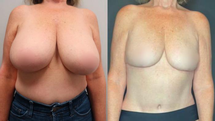 Breast Reduction, Front Photo, Calgary Alberta, Demsey Plastic Surgery 