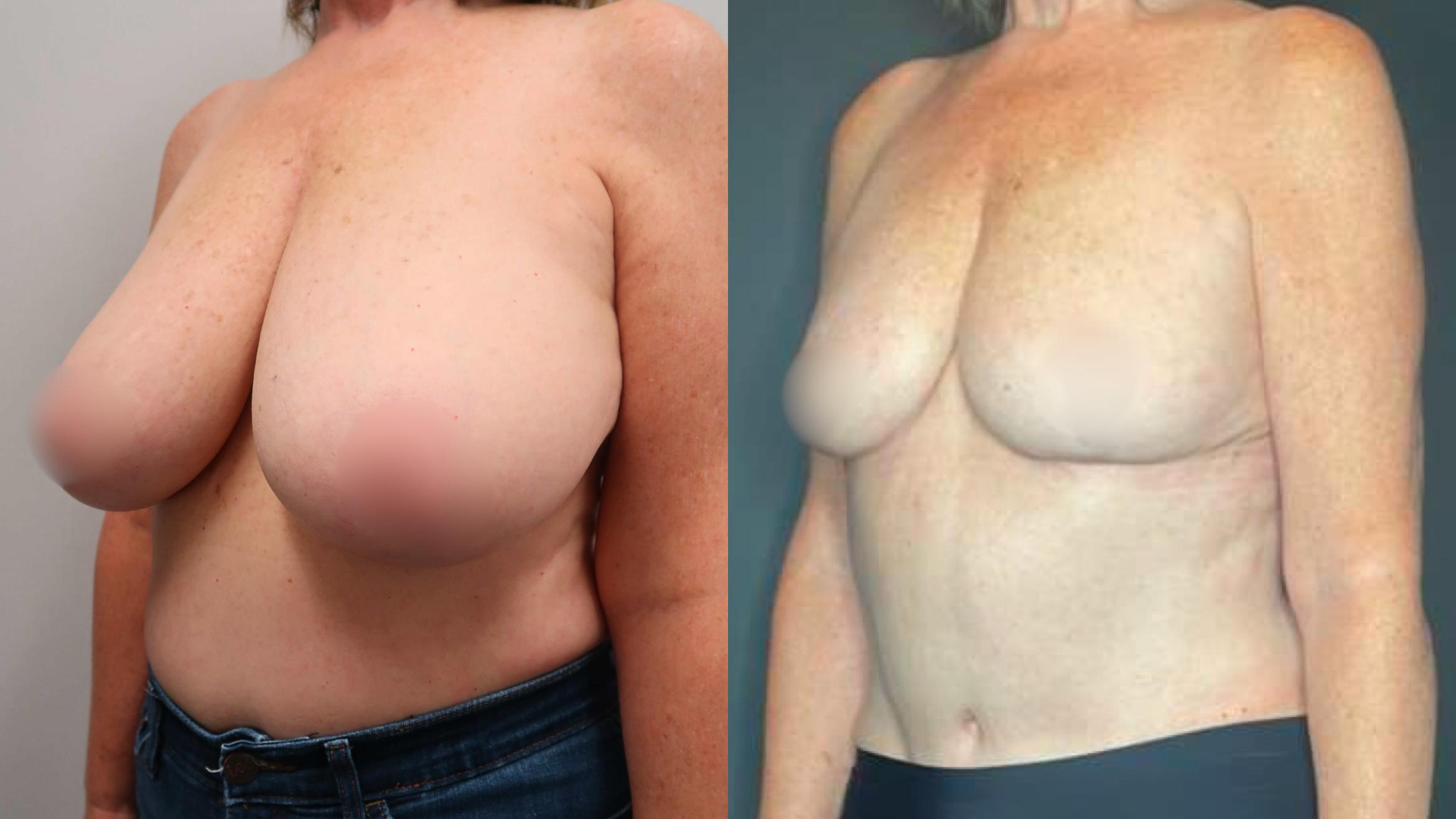 Breast Reduction, Left Oblique Photo, Calgary Alberta, Demsey Plastic Surgery 