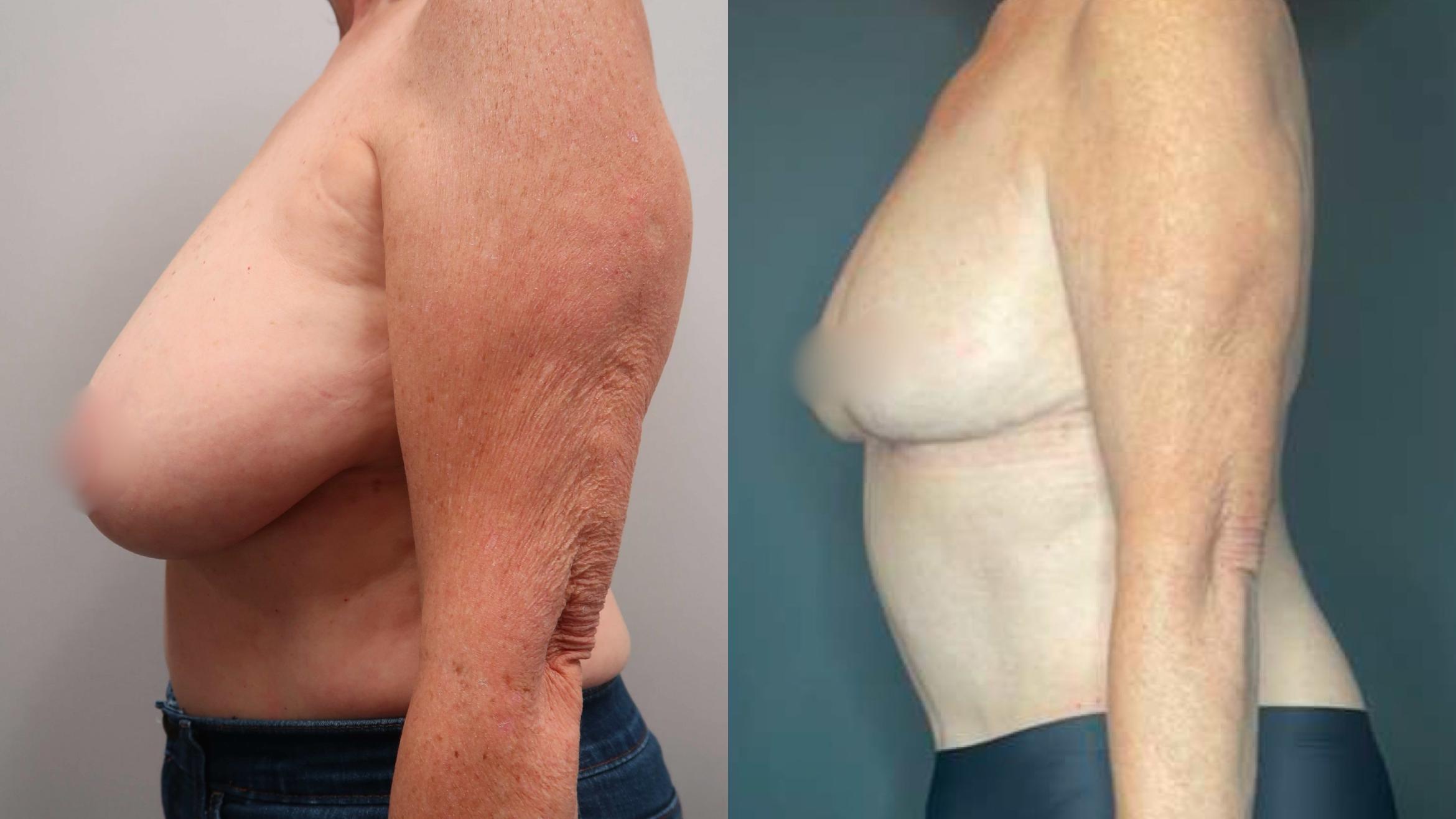 Breast Reduction, Left Side Photo, Calgary Alberta, Demsey Plastic Surgery 