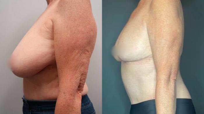 Breast Reduction, Left Side Photo, Calgary Alberta, Demsey Plastic Surgery 