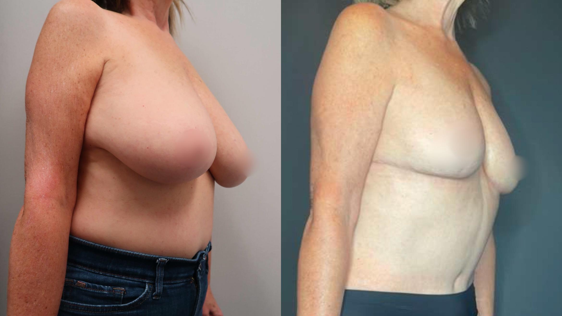 Breast Reduction, Right Oblique Photo, Calgary Alberta, Demsey Plastic Surgery 
