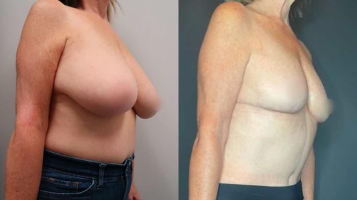 Breast Reduction, Right Oblique Photo, Calgary Alberta, Demsey Plastic Surgery 