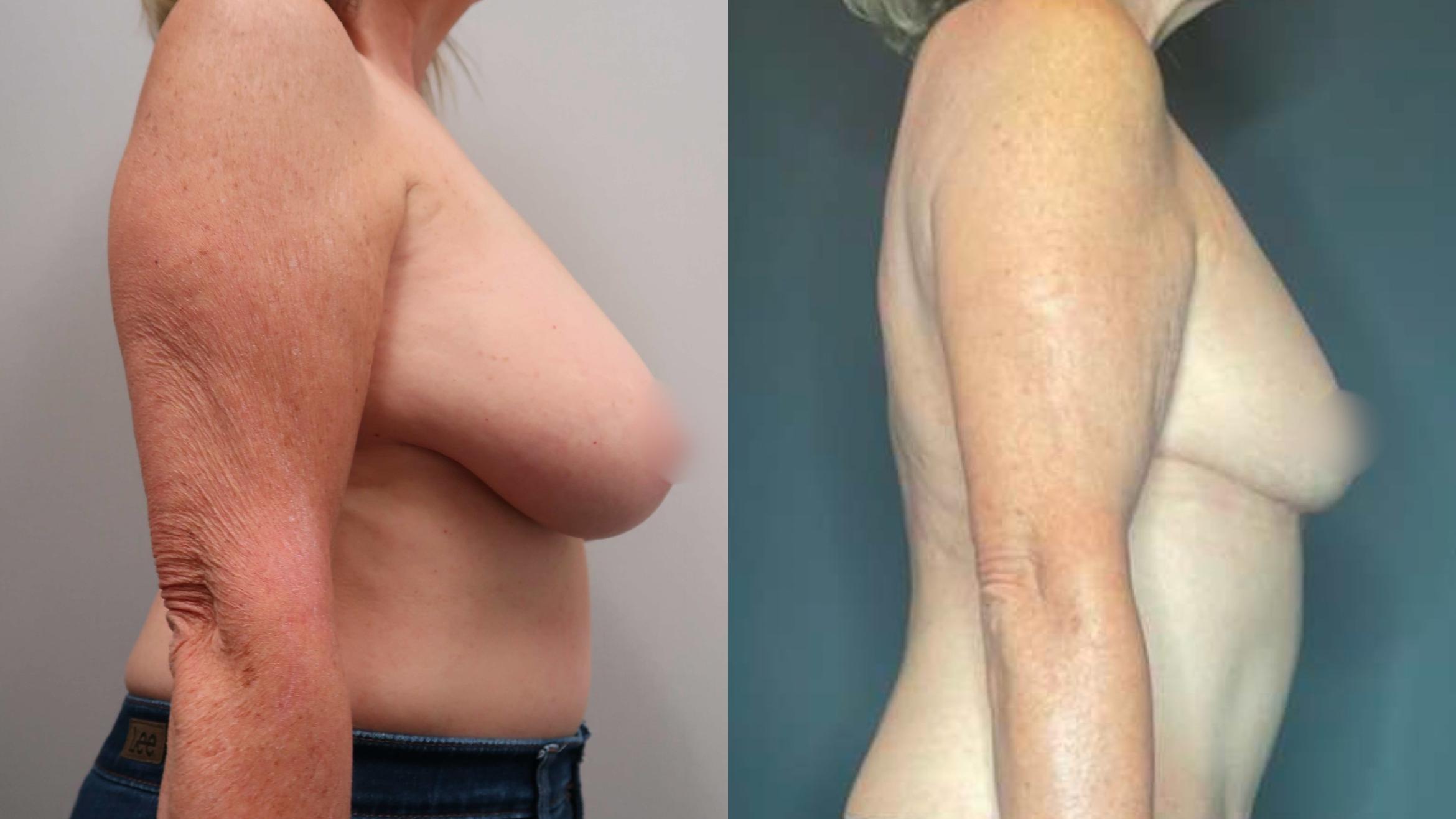 Breast Reduction, Right Side Photo, Calgary Alberta, Demsey Plastic Surgery 