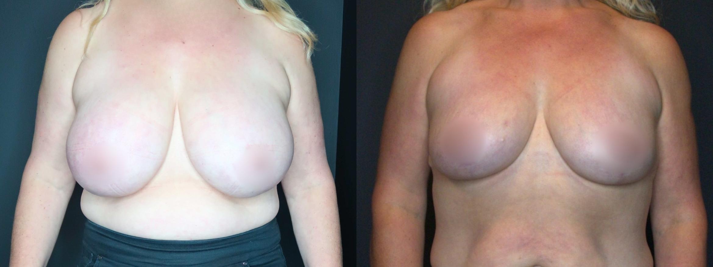 Breast Reduction, Front Photo, Calgary Alberta, Demsey Plastic Surgery 