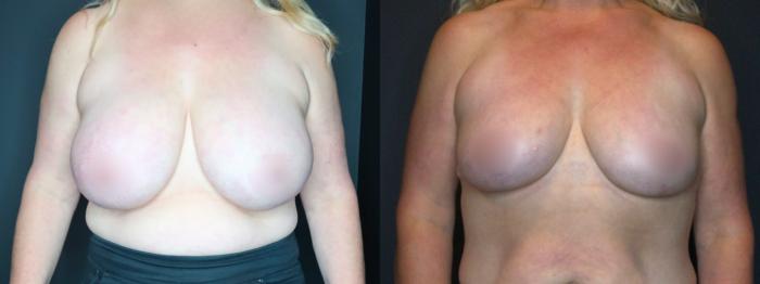 Breast Reduction, Front Photo, Calgary Alberta, Demsey Plastic Surgery 