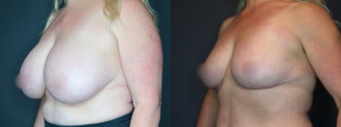 Breast Reduction, Left Oblique Photo, Calgary Alberta, Demsey Plastic Surgery 