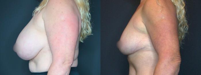 Breast Reduction, Left Side Photo, Calgary Alberta, Demsey Plastic Surgery 