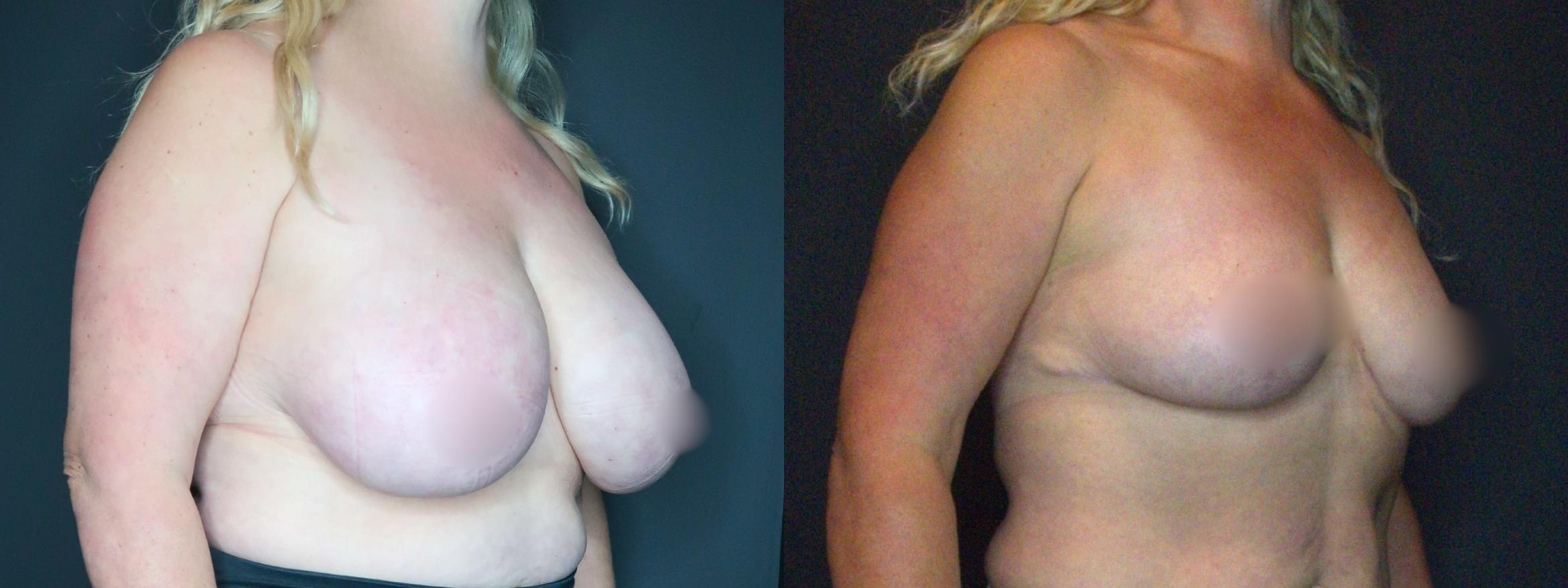 Breast Reduction, Right Oblique Photo, Calgary Alberta, Demsey Plastic Surgery 