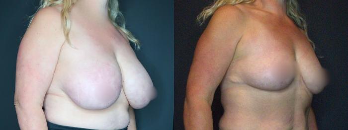 Breast Reduction, Right Oblique Photo, Calgary Alberta, Demsey Plastic Surgery 