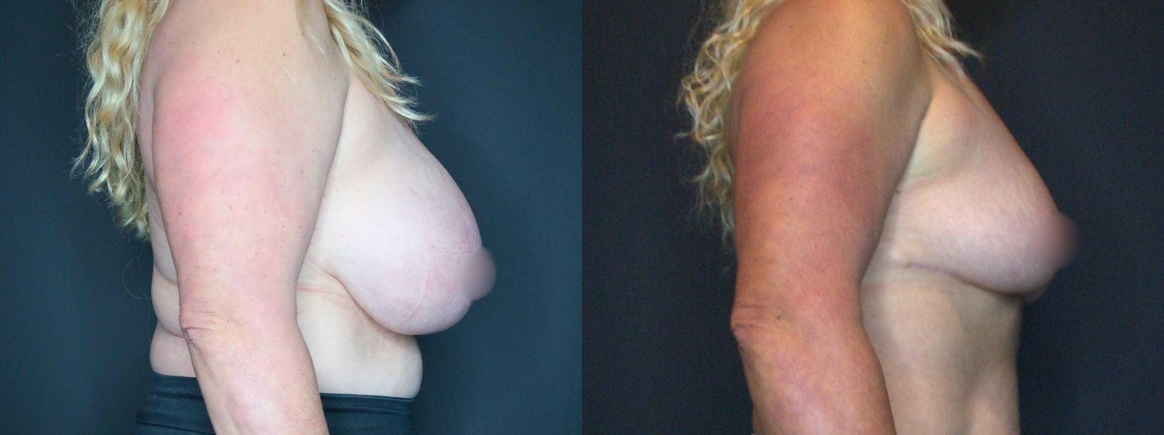 Breast Reduction, Right Side Photo, Calgary Alberta, Demsey Plastic Surgery 