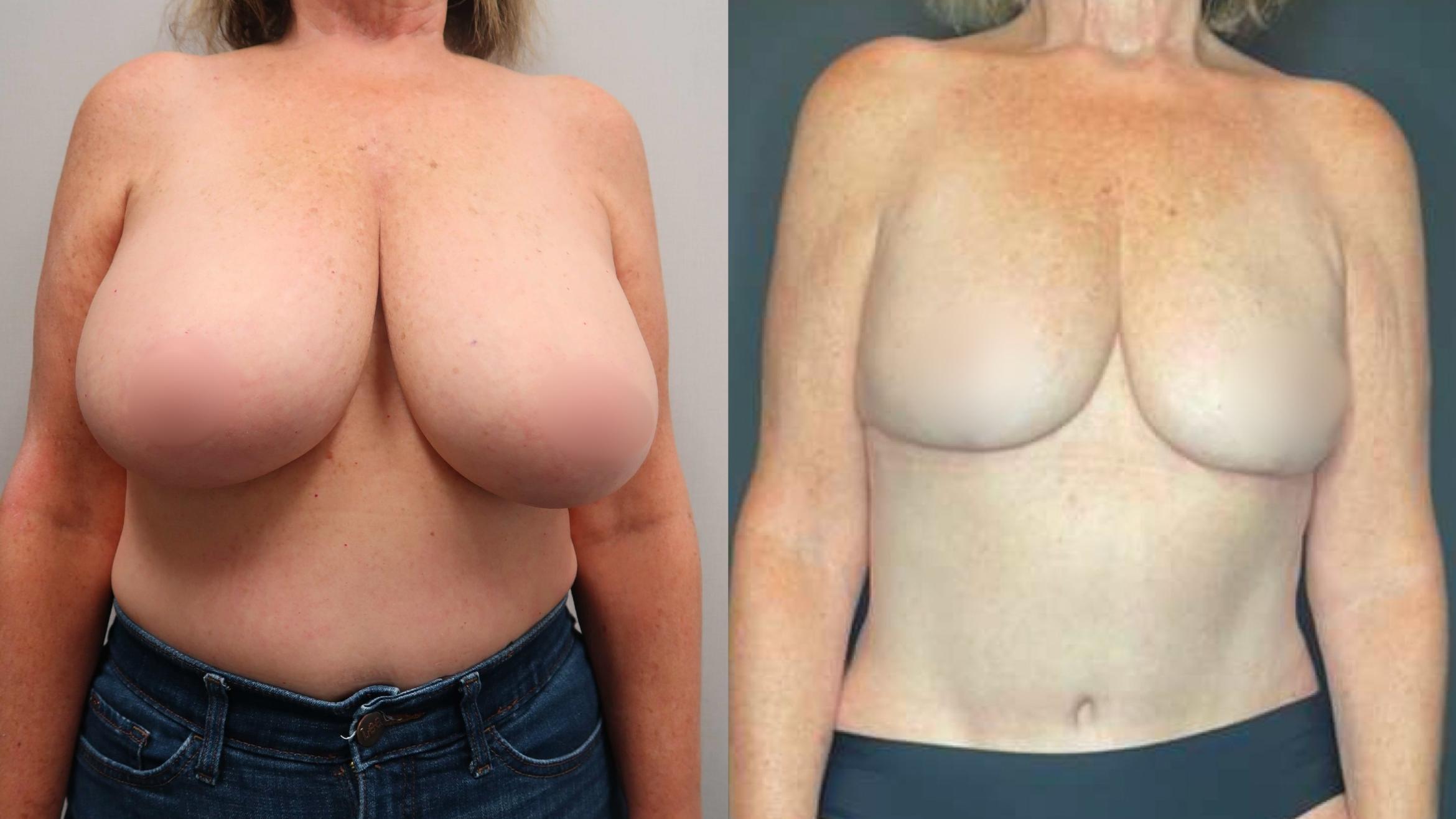 Breast Reduction, Front Photo, Calgary Alberta, Demsey Plastic Surgery 