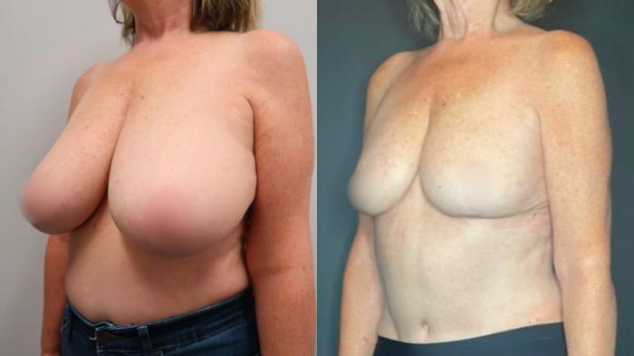 Breast Reduction, Left Oblique Photo, Calgary Alberta, Demsey Plastic Surgery 