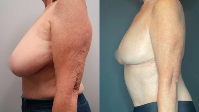 Breast Reduction, Left Side Photo, Calgary Alberta, Demsey Plastic Surgery 