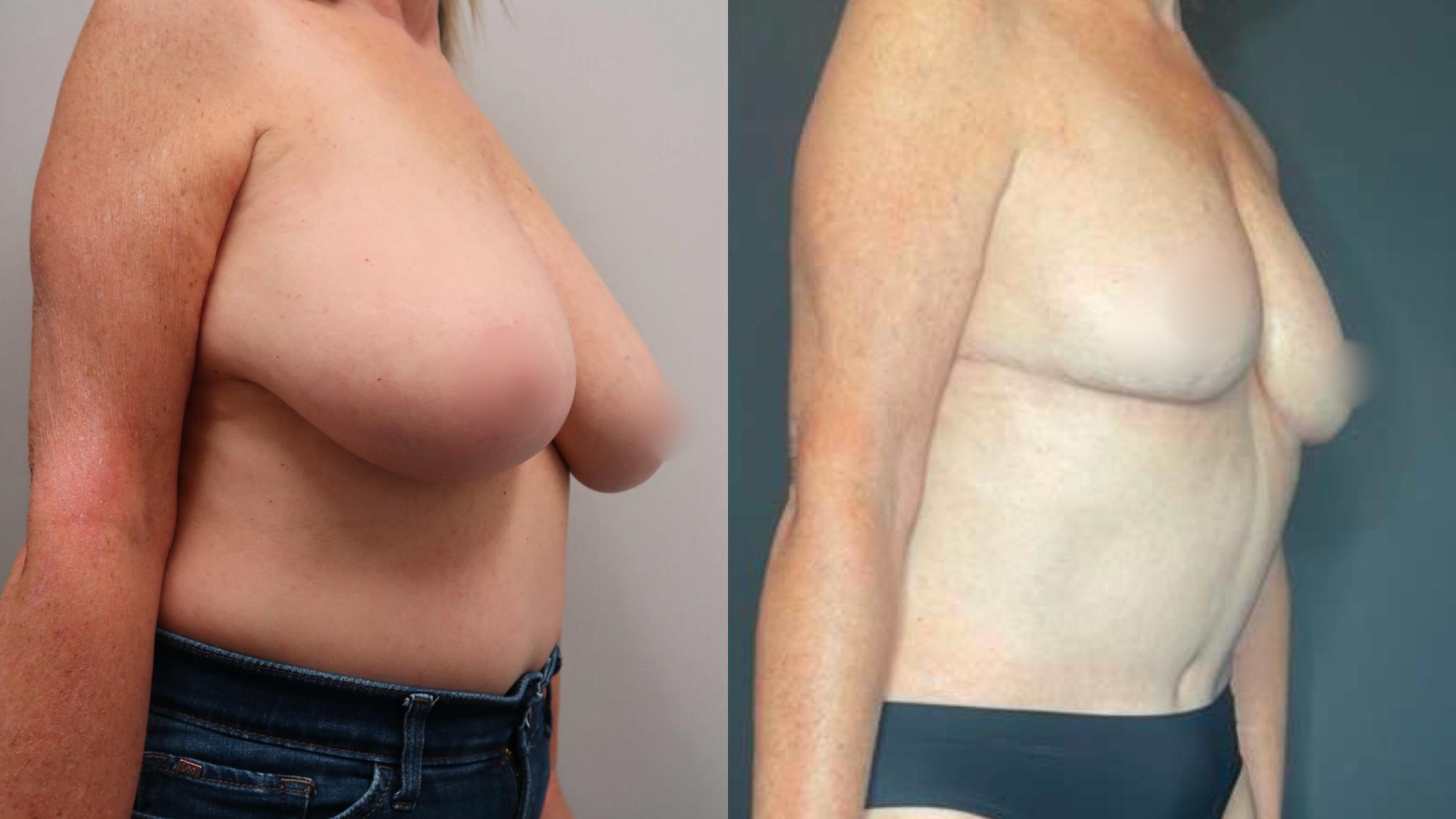 Breast Reduction, Right Oblique Photo, Calgary Alberta, Demsey Plastic Surgery 