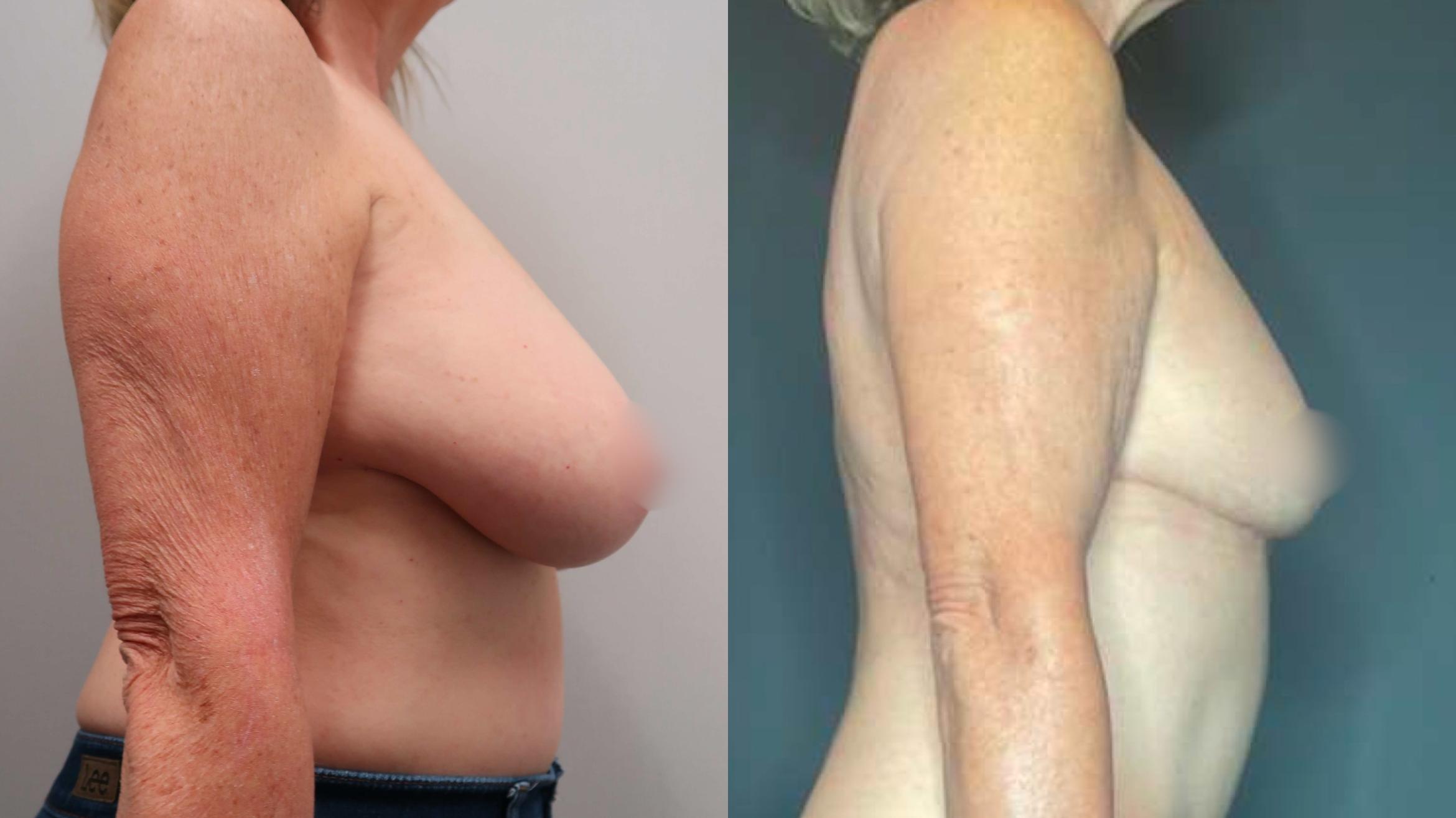 Breast Reduction, Right Side Photo, Calgary Alberta, Demsey Plastic Surgery 
