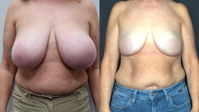 Breast Reduction, Front View Photo, Calgary Alberta, Demsey Plastic Surgery 