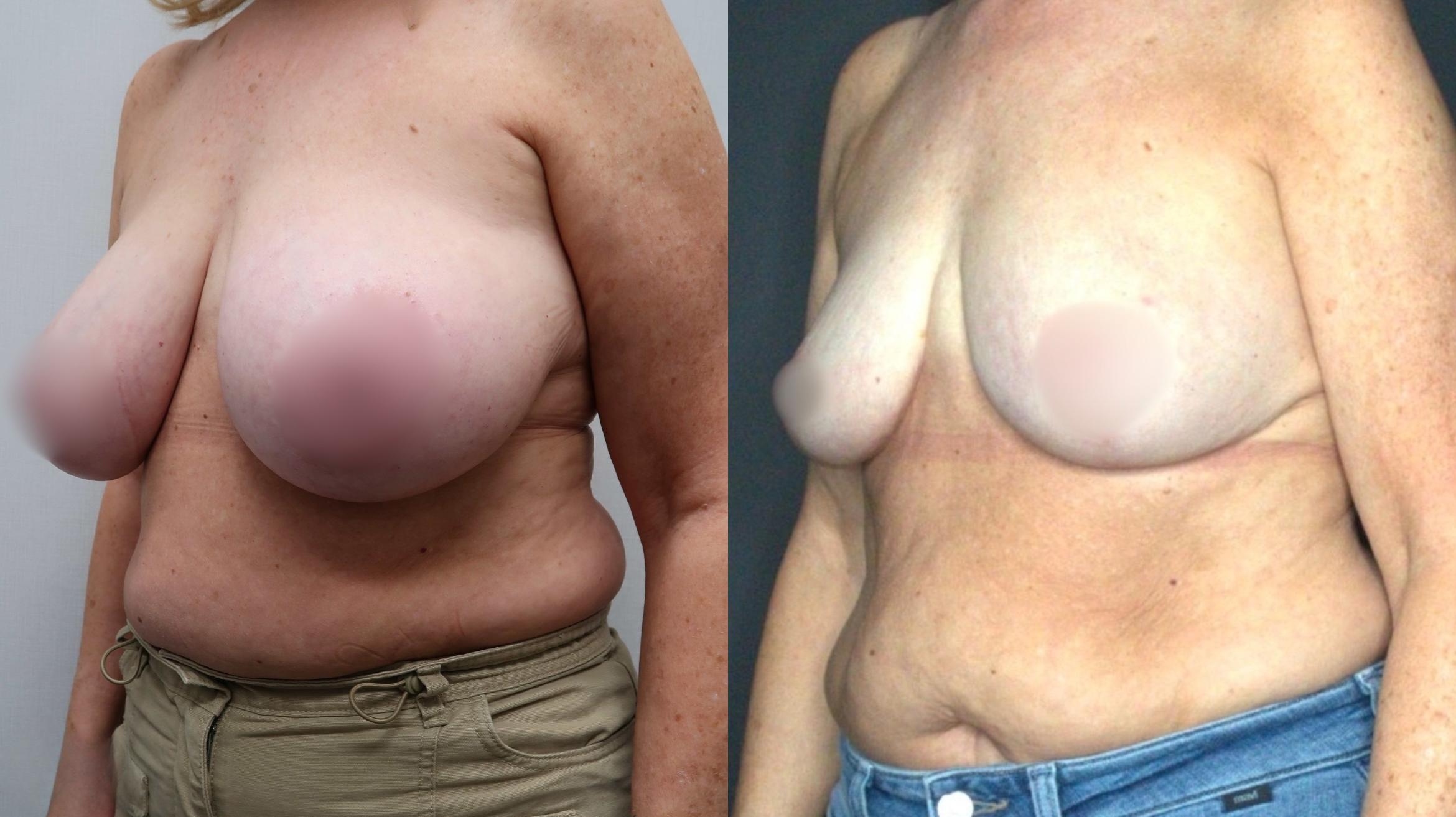 Breast Reduction, Left Oblique Photo, Calgary Alberta, Demsey Plastic Surgery 