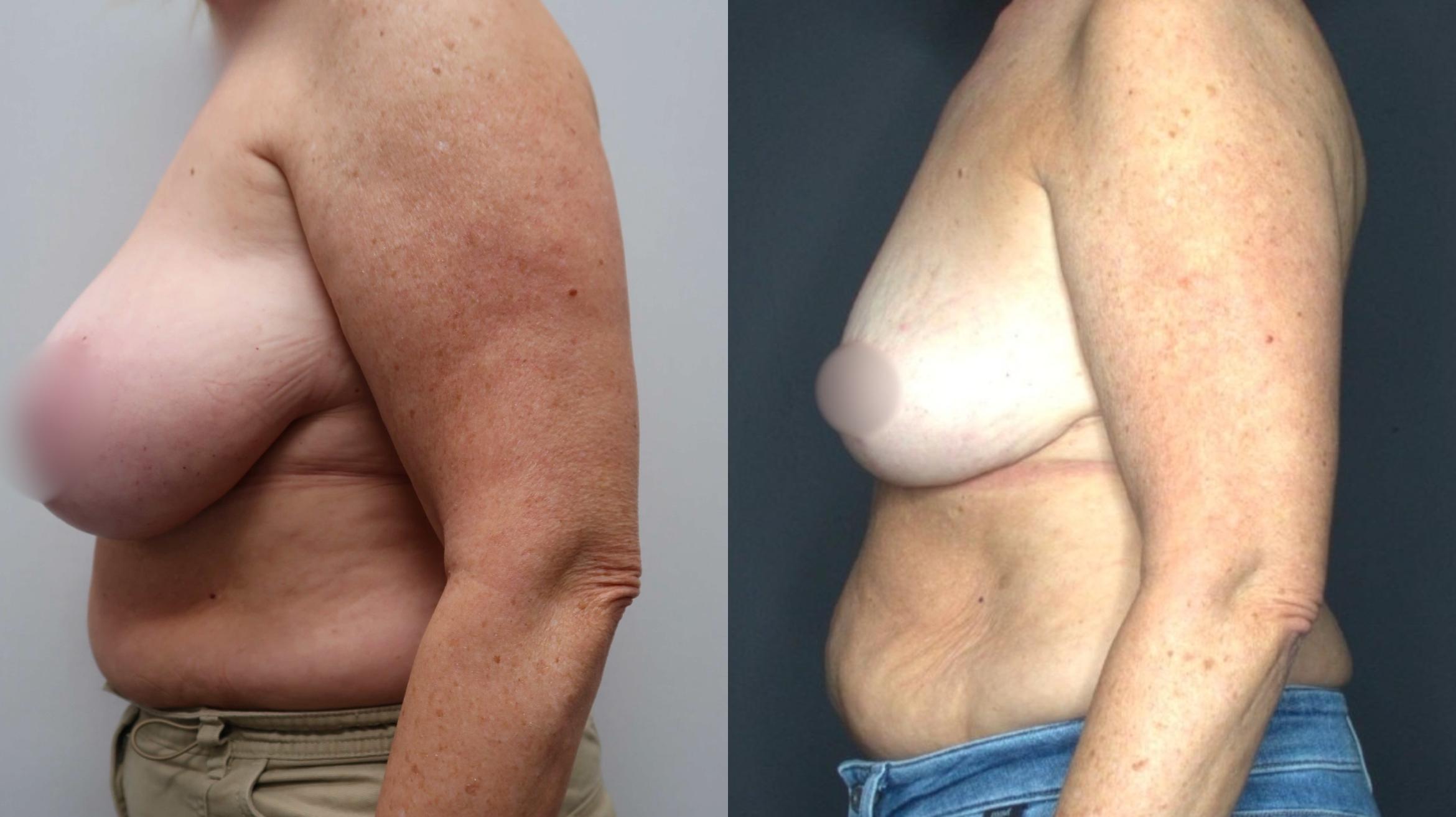 Breast Reduction, Left Side Photo, Calgary Alberta, Demsey Plastic Surgery 