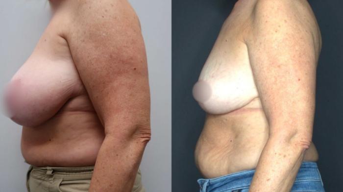 Breast Reduction, Left Side Photo, Calgary Alberta, Demsey Plastic Surgery 