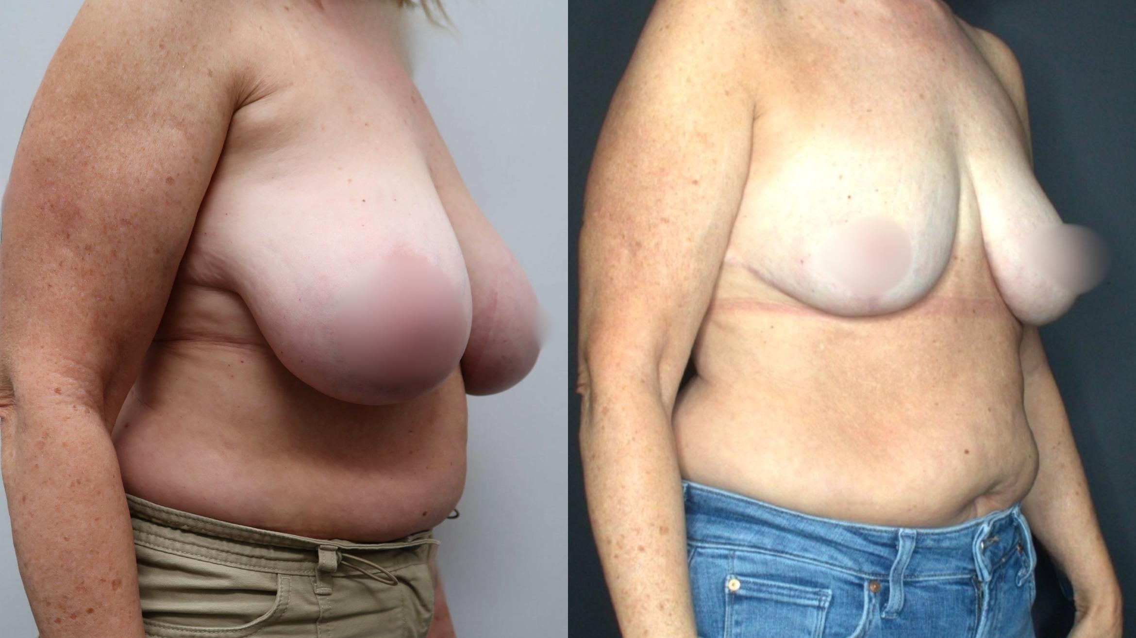 Breast Reduction, Right Oblique Photo, Calgary Alberta, Demsey Plastic Surgery 